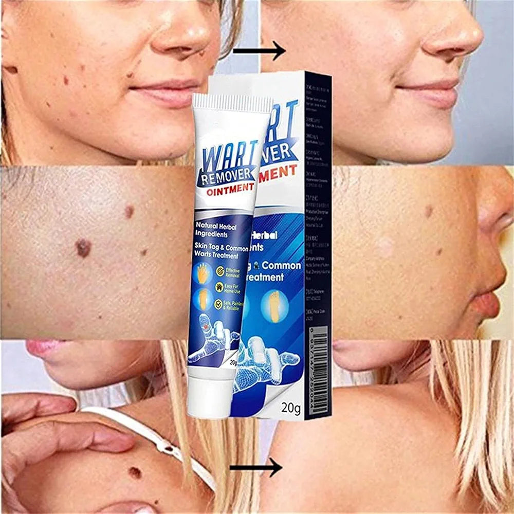 ✨ Wart &amp; Skin Tag Remover – كريم لإزالة الزوائد الجلدية والثآليل