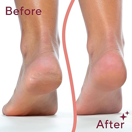 👣 Electric Callus Remover – جهاز إزالة الجلد الميت لبشرة ناعمة فوراً
